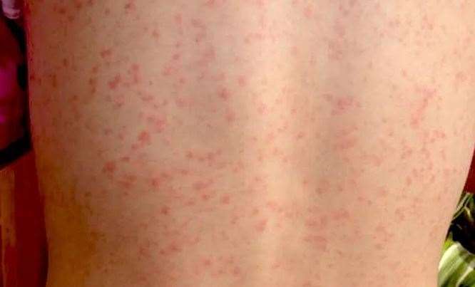 Scarlet fever: This is how many cases of the highly contagious infection  caused by the Strep A bacteria have been reported in Lancashire